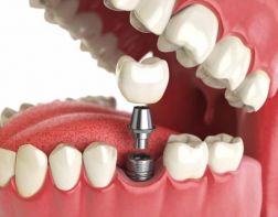 Протезирование зубов: стоит ли оно того и какие бывают разновидности